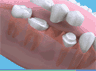 the London Dentist Studio bridges treatment information