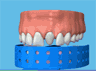 the London Dentist Studio crown treatment information