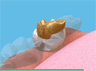 the London Dentist Studio inlays treatment information