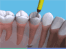 the London Dentist Studio root treatment information