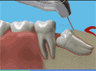 the London Dentist Studio wisdom treatment information