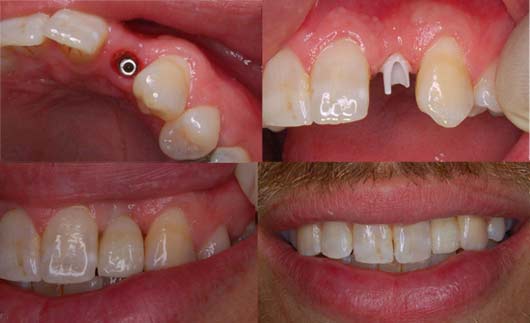 4 pics of a tooth implant