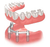 implants