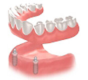 implants