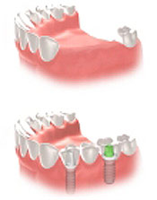 missing several teeth implants