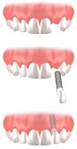 missing single tooth impant