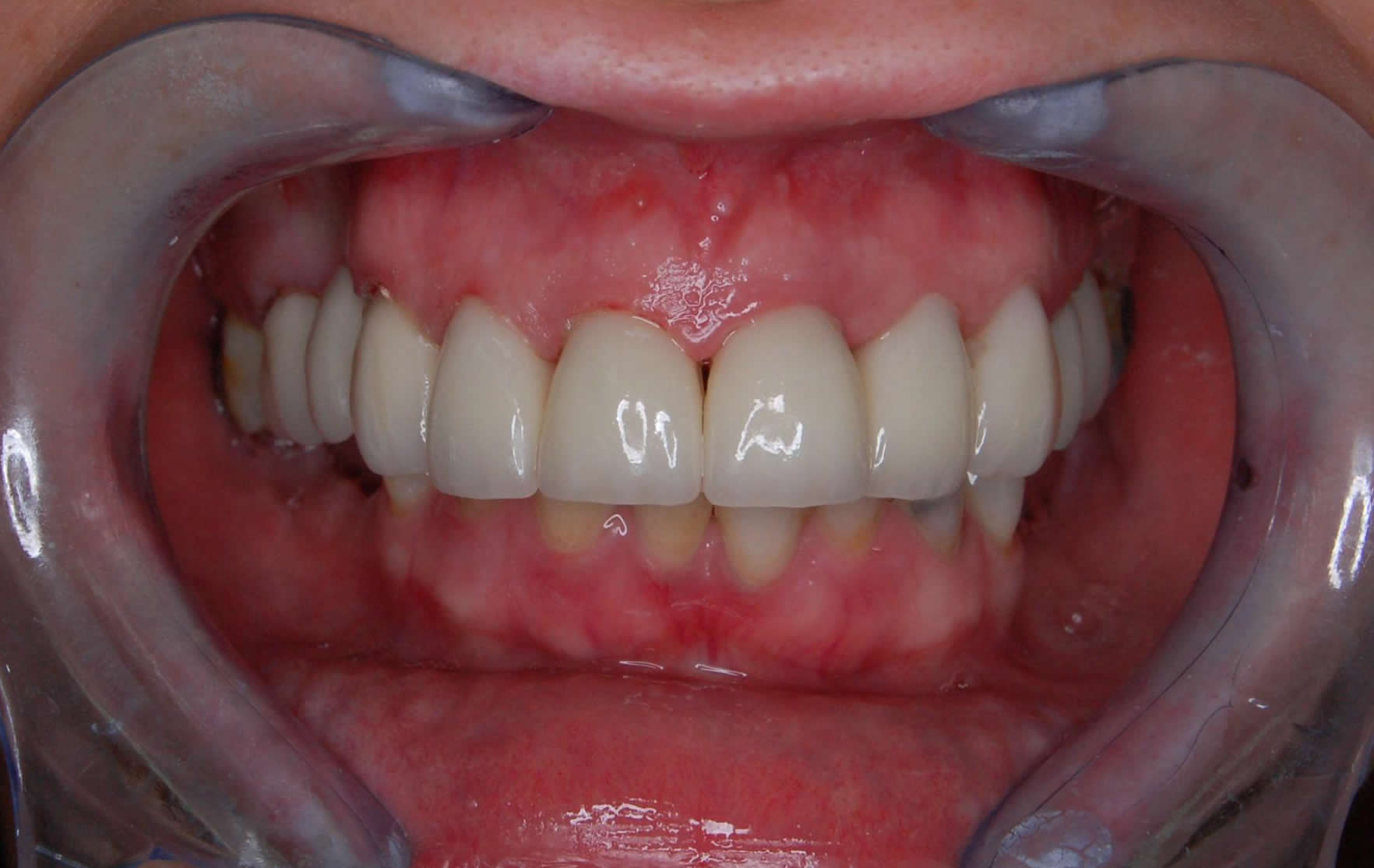 smile after