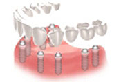implants
